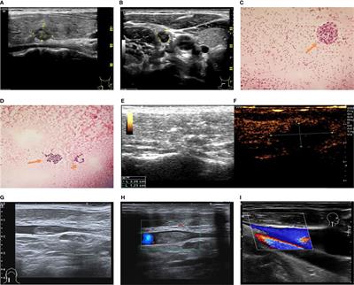 Internal Jugular Vein Thrombosis After Microwave Ablation of Cervical Lymph Node Metastasis in Papillary Thyroid Microcarcinoma: A Case Report